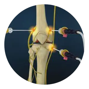 RFA for Knee Ostheoarthritis