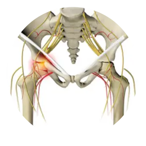 Avascular Necrosis (RFA) Radiofrequency Ablation