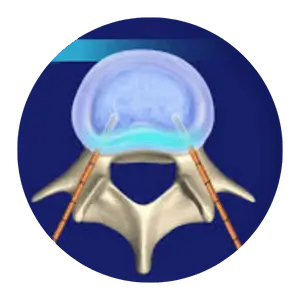 Biacuplasty for Annual Tear