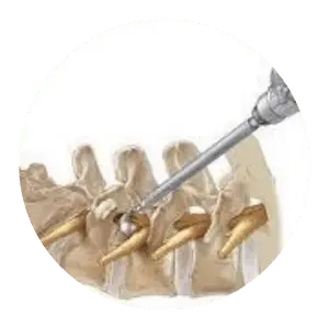 Spine Endoscopy for back pain treatment