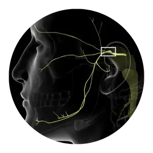 Trigeminal Neuralgia